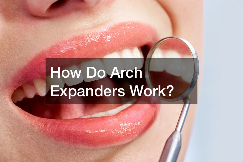 How Do Arch Expanders Work? Best Dentist Directory
